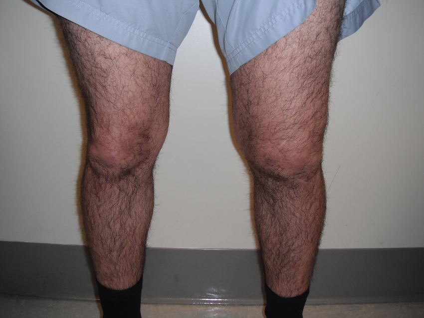 Knee effusion